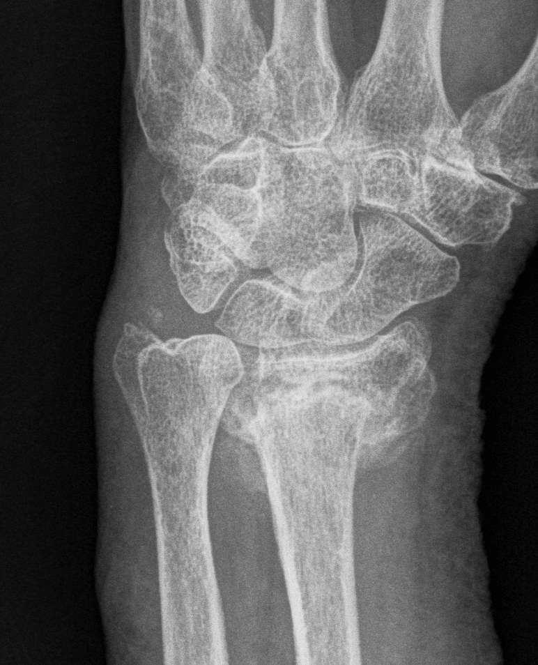 Radial Malunion